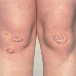 Example of psoriasis